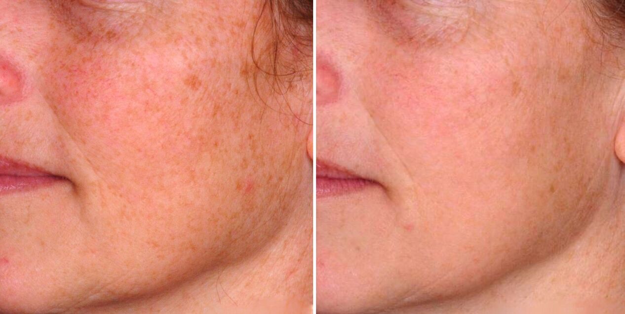 Hasil daripada photothermolysis pecahan adalah pengurangan bintik-bintik penuaan pada kulit muka. 