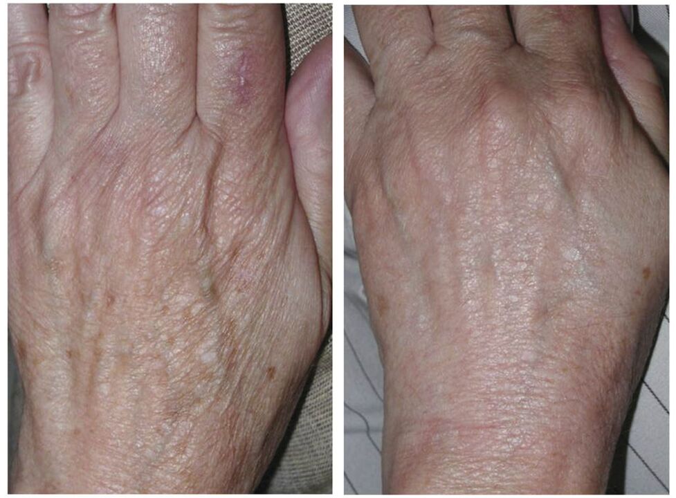 laser peremajaan tangan sebelum dan selepas gambar